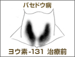 画像:シンチグラフィ・バセドウ病治療前