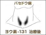 画像:シンチグラフィ・バセドウ病病治療後