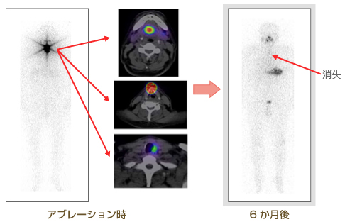 画像：甲状腺がん・アブレーション