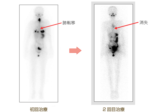 画像：24歳女性　濾胞癌