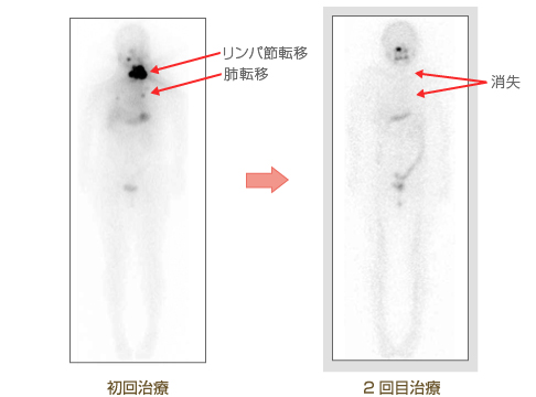 画像：46歳女性　乳頭癌、濾胞癌