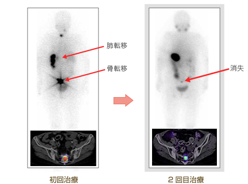 画像：70歳初発　濾胞癌