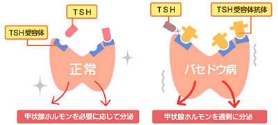 解説図：正常な甲状腺とバセドウ病の甲状腺